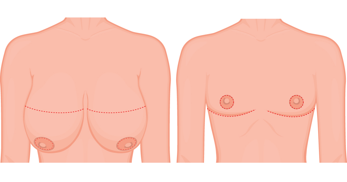Vị trí vết mổ ngực : Vết thương hình chữ I hoặc nằm ngang